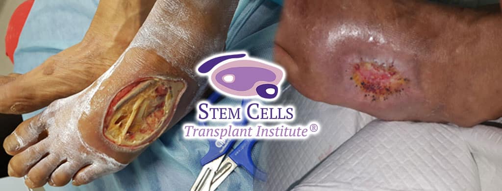 Foot ulcer Stem Cells Case Study